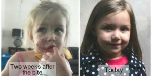 Little girl that was bit by a dog showed before and after recovery