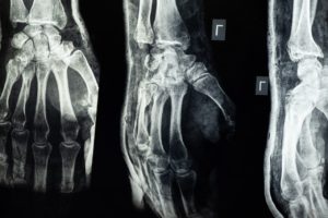 common t-bone accident injuries