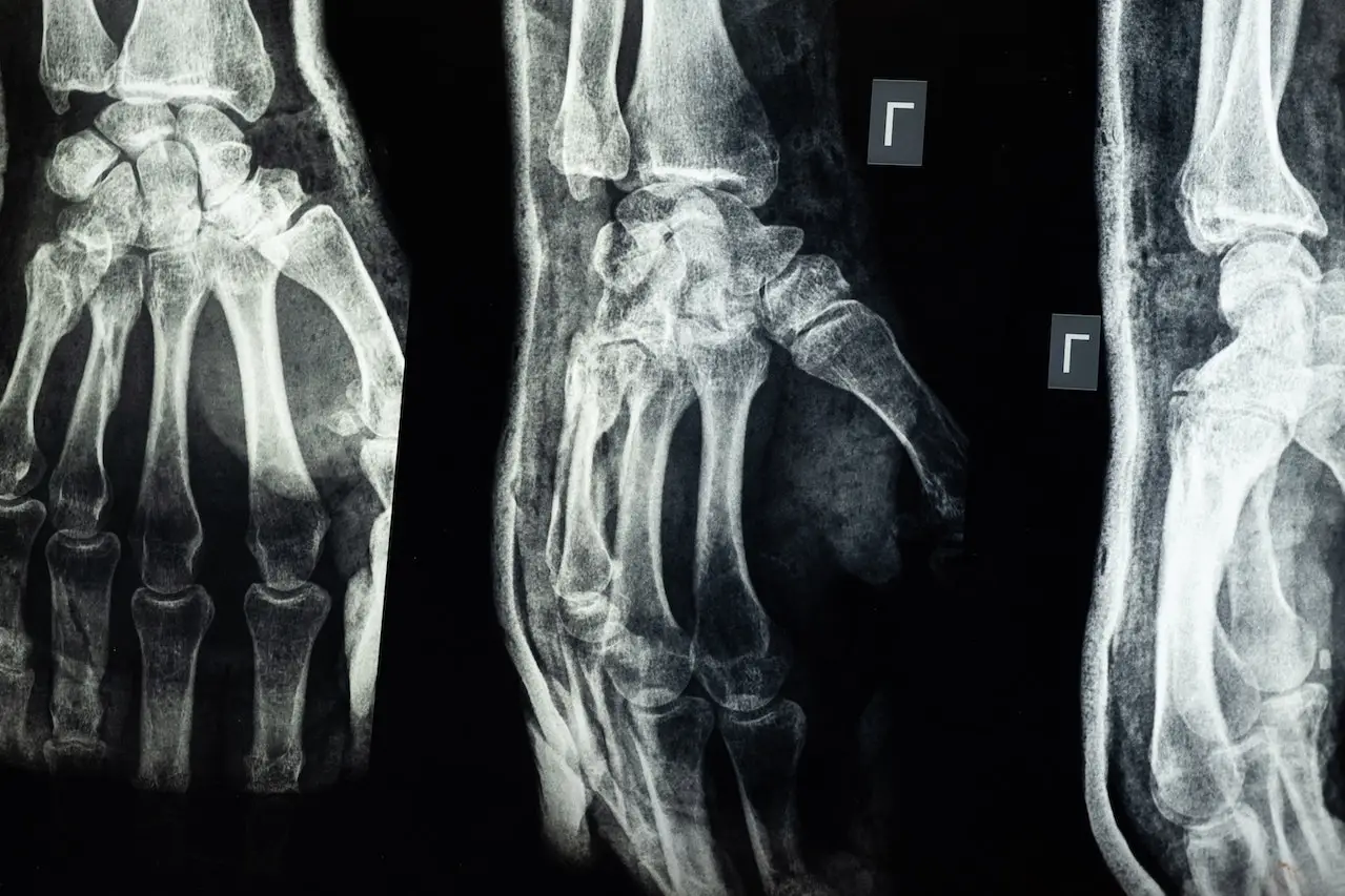 What Type of Injury Is Commonly Associated with T-Bone Accidents?